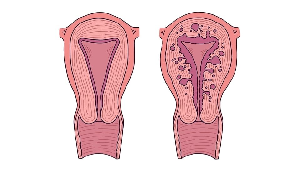 Adenomyozis: Rahim Duvarında Gizlenen Kronik Hastalık